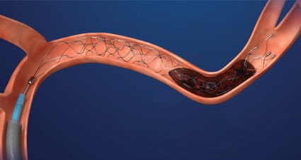 stent.jpg